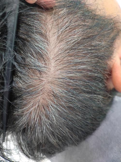 十几根白头发正常吗_白发增多?遗传压力大?这几点帮你应对 十几根白头发正常吗_白发增多?遗传压力大?这几点帮你应对