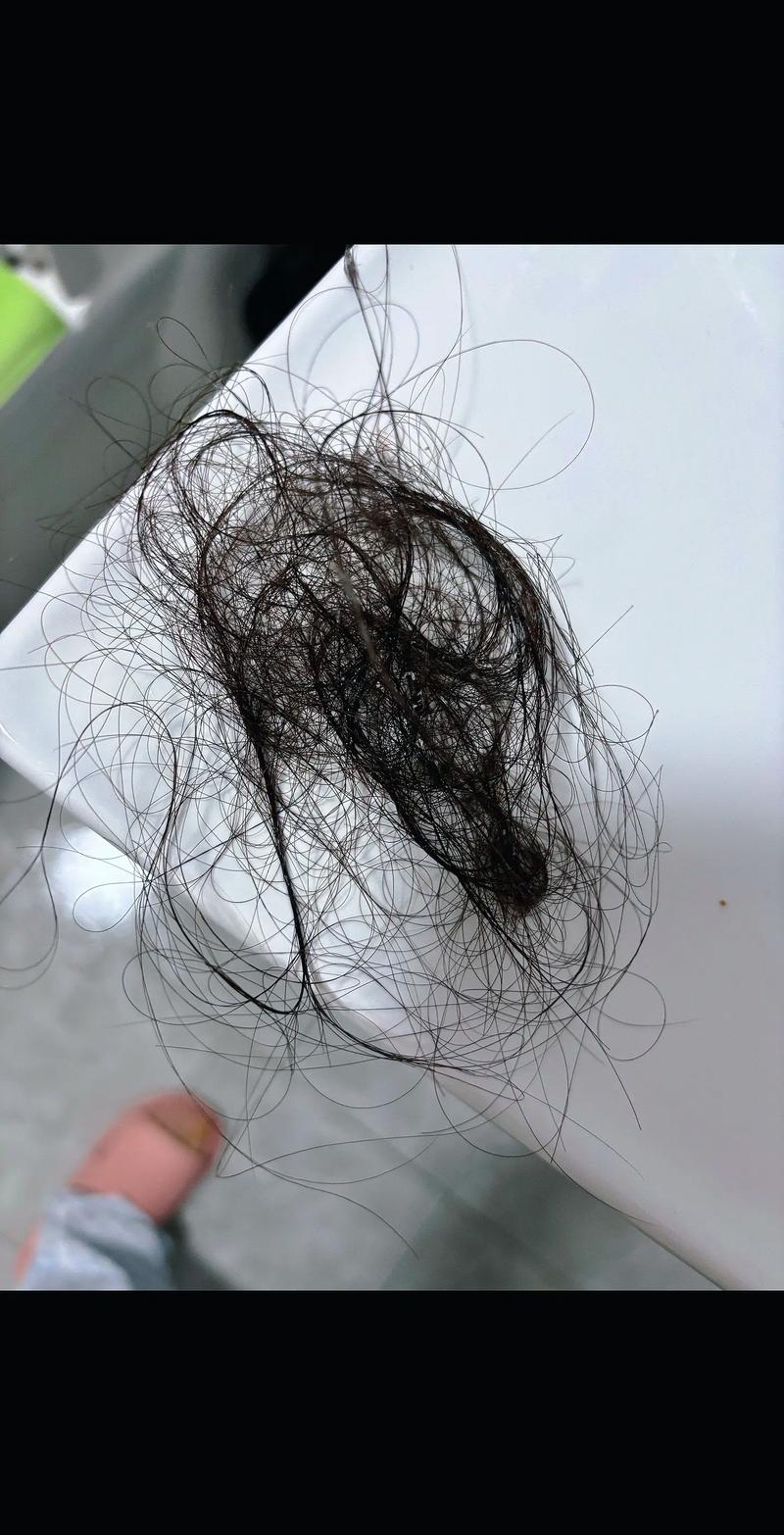 被人使劲拽头发后脱发严重_拉扯伤发根，压力大营养差要当心！