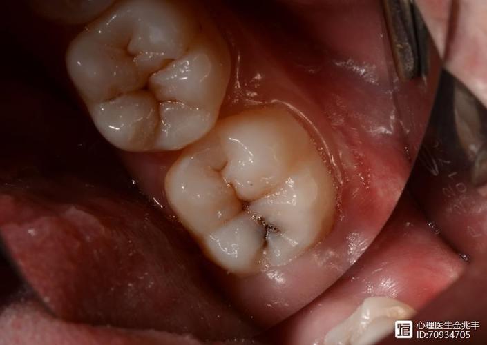 拔牙前能不能染头发_拔牙后别染发，易感染伤口