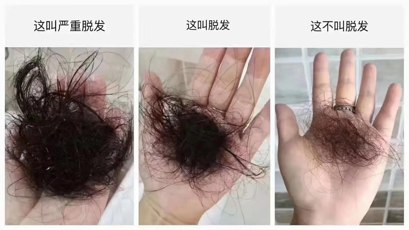捋一下头发掉几根算脱发_脱发超100根要当心,注意生活习惯和就医 捋一下头发掉几根算脱发_脱发超100根要当心,注意生活习惯和就医