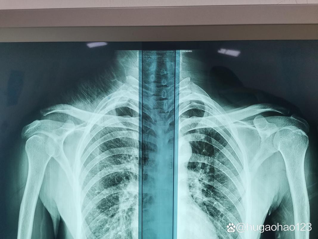 拍肩关节正位片什么姿势_肩正位片拍姿要标准,侧位片患侧紧贴 拍肩关节正位片什么姿势_肩正位片拍姿要标准,侧位片患侧紧贴