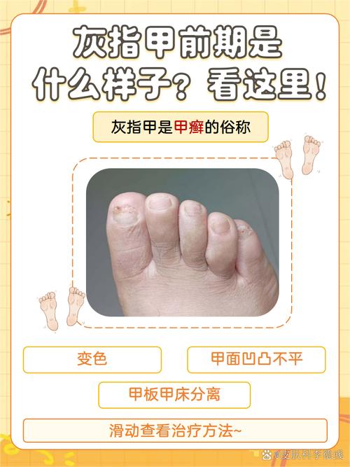 灰指甲是什么颜色_灰指甲颜色多样，从白到黑，防患于未然是关键！